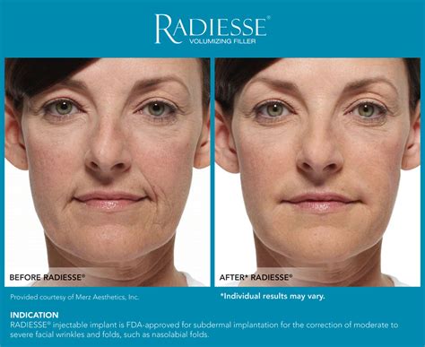 radiesse adalah|Radiesse® Overview: Cost, Recovery, Before & After .